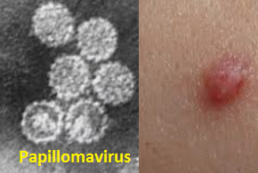 papillomavirus laryngee