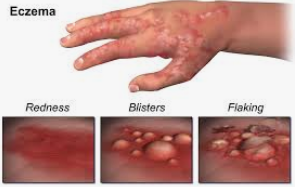 Eczema  photos