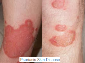 psoriasis skin disease cutané photos