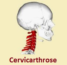 Cervicarthrose  Arthrose cervicale