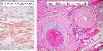 AMYLOSE amylosis