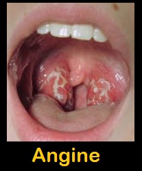 angine streptococcique pharyngite