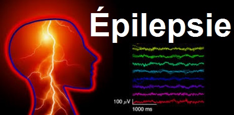 CRISES COMITIALES épilepsies