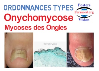ONYCHOMYCOSES