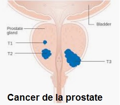 Cancer de la prostate
