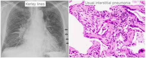 PULMONARY INTERSTITIAL SYNDROME