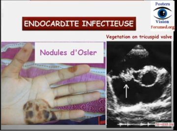 Endocardite Infectieuse – Santé Médecine