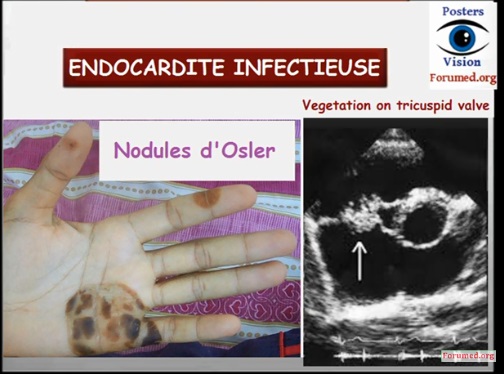 Endocardite infectieuse  