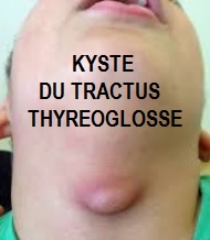 KYSTE DU TRACTUS THYREOGLOSSE

