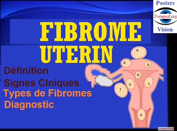 FIBROME UTERIN Fibromyome Myome utérin Fibroléiomyome