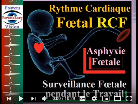 Prévenir une Asphyxie néonatale par Surveillance du Rythme cardiaque fœtal RCF