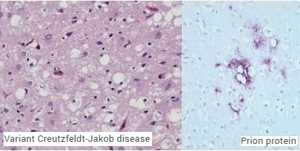 Creutzfeldt-Jakob Disease prion protein