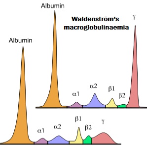 Waldenström's macroglobulinaemia 
