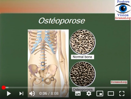 Ostéoporose définition et les facteurs de risque
