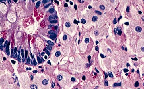 Accumulation of foamy macrophages in small intestinal lamina propria, in Whipple's disease
