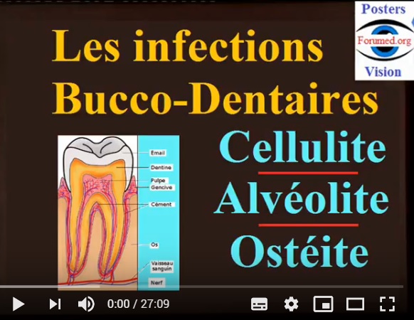 Infections bucco-dentaires: Cellulite Alvéolite Ostéite
