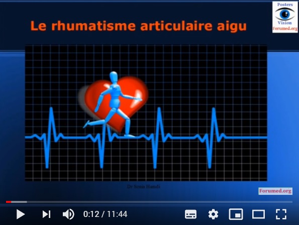 Rhumatisme articulaire aigu RAA et le risque d'une maladie cardiaque
