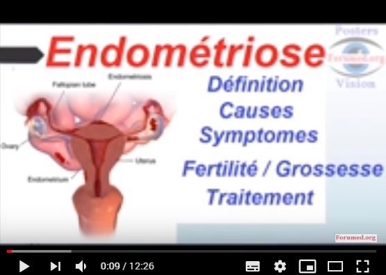 Endométriose: Causes Symptomes Diagnostic Traitement 