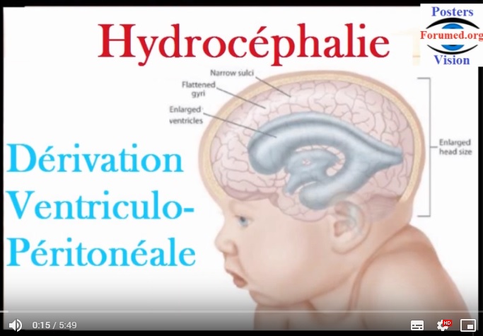 Hydrocephalie derivation valve VENTRICULO PERITONEAL du liquide cérébro-spinal SHUNT
