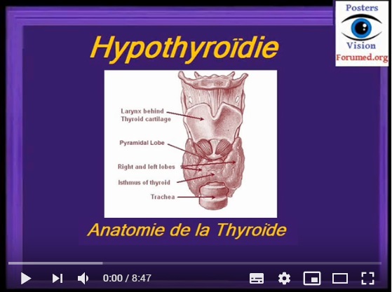 Hypothyroidie: comment reconnaitre un debut de goitre
