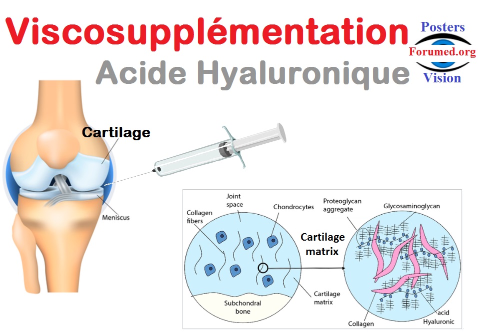 ViscoSupplémentation: injection intra articulaire d'acide hyaluronique