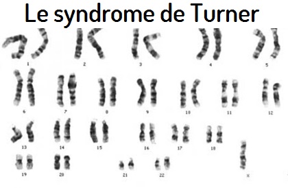 Le syndrome de Turner