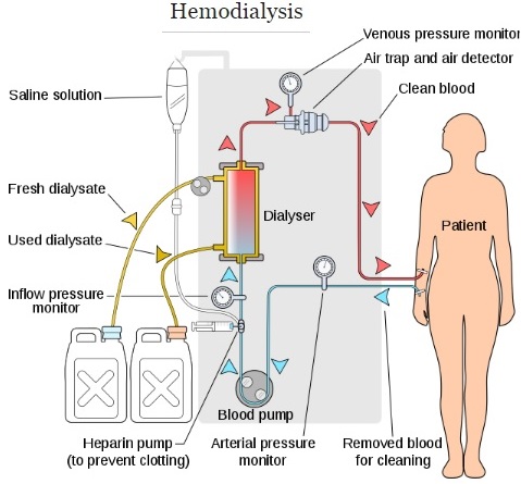 Les 3 techniques d’épuration extra-rénale  hémodialyse