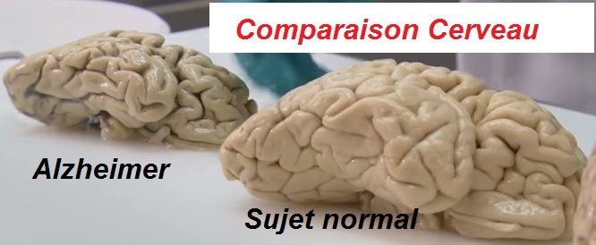 Alzheimer comparaison avec le Cerveau Normal