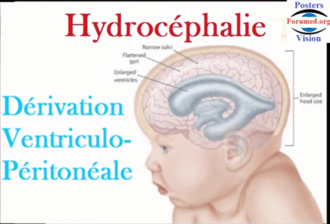Hydrocéphalie et dérivation ventriculo-péritonéale du liquide cérébro-spinal