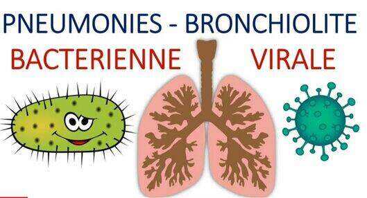 Pneumonie aigue communautaire bactérienne virale atypique