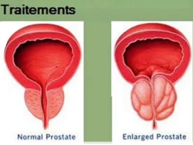 Traitement médical de l’hypertrophie bénigne de la prostate