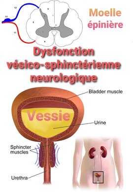 Dysfonction vésico-sphinctérienne neurologique