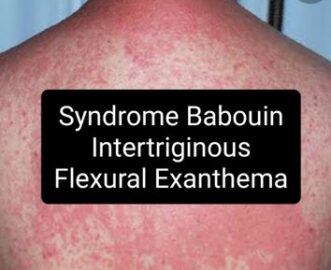 Syndrome babouin Symmetrical Drug-Related Intertriginous and Flexural ...