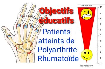 Objectifs éducatifs des patients atteints de polyarthrite rhumatoïde