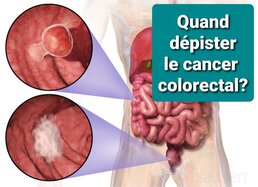 Les facteurs de risque du cancer colorectal