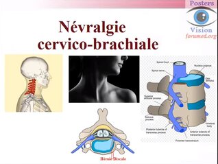 Névralgie cervico-brachiale cervicalgie cervicarthrose arthrose 
