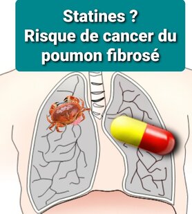 statines risque cancer du poumon fibrose pulmonaire